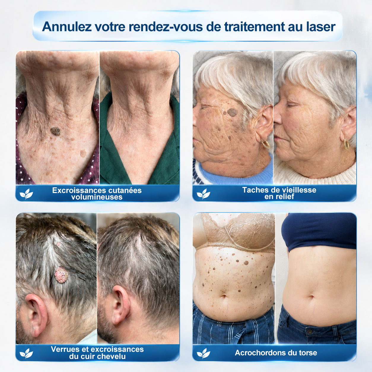 Oficiální obchod značky👨‍🔬𝐏𝐢𝐜𝐝𝐨® 7denní odstraňovač kožních výrůstků a pigmentových skvrn (Bez bolesti, bez jizev – Roll-on)