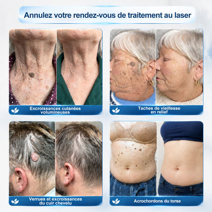 Oficiální obchod značky👨‍🔬𝐏𝐢𝐜𝐝𝐨® 7denní odstraňovač kožních výrůstků a pigmentových skvrn (Bez bolesti, bez jizev – Roll-on)