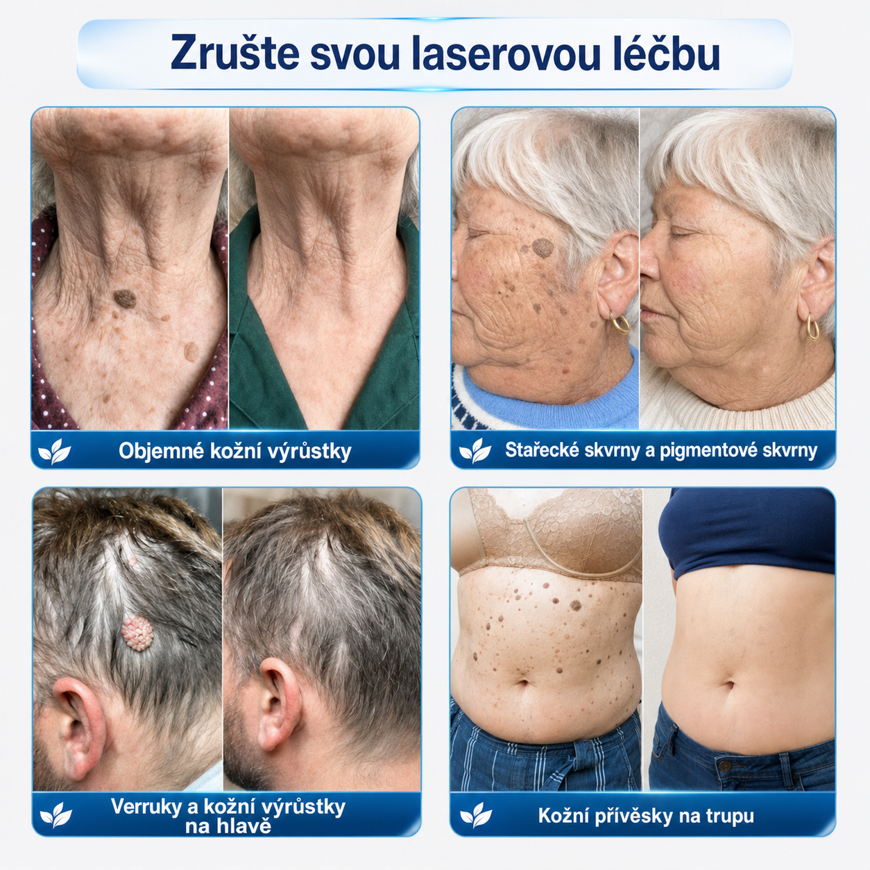 Oficiální obchod značky👨‍🔬Trilumia® 7denní odstraňovač kožních výrůstků a pigmentových skvrn (Bez bolesti, bez jizev – Roll-on)-01
