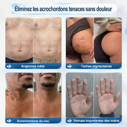 Oficiální obchod značky👨‍🔬𝐏𝐢𝐜𝐝𝐨® 7denní odstraňovač kožních výrůstků a pigmentových skvrn (Bez bolesti, bez jizev – Roll-on)