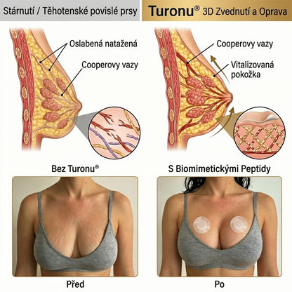 💥Turonu® 👨‍🔬Pokročilé nano-mikroihlové náplasti na cielené tvarování poprsia💃