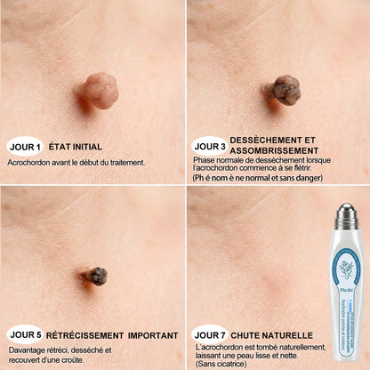 Oficiální obchod značky👨‍🔬𝐏𝐢𝐜𝐝𝐨® 7denní odstraňovač kožních výrůstků a pigmentových skvrn (Bez bolesti, bez jizev – Roll-on)