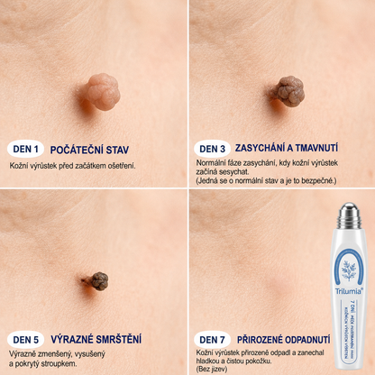 Oficiální obchod značky👨‍🔬Trilumia® 7denní odstraňovač kožních výrůstků a pigmentových skvrn (Bez bolesti, bez jizev – Roll-on)-01